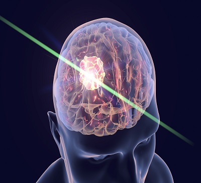 Global Brain Cancer Imaging Market 2018-2022